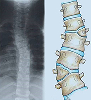 Csigolyafejlődési rendelenesség - röntgen