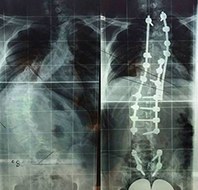 Csigolyafejlődési rendelenesség - röntgen